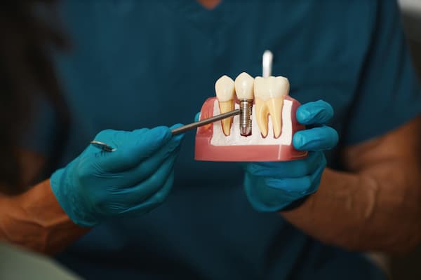 Permanent Dental Implants